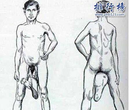 世界上最奇葩的脑袋:“半脑哥”因车祸切掉半个脑袋(侧面惊人)
