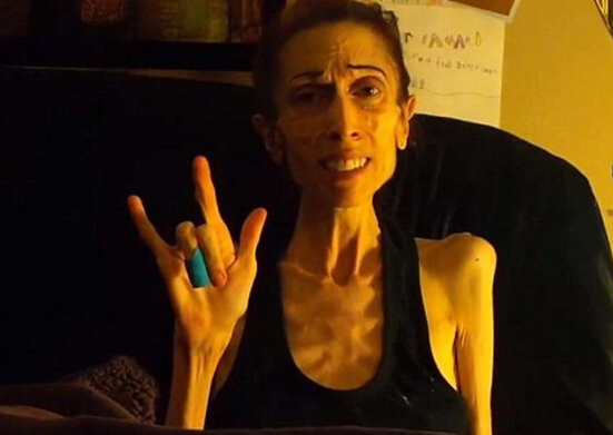 厌食症：骨感身材后的恶魔（死亡率高达20%）