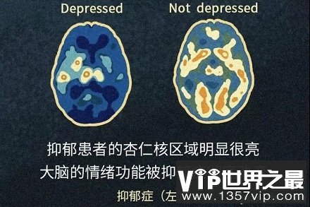 为什么抑郁症患者会有更多的"负面情绪"？
