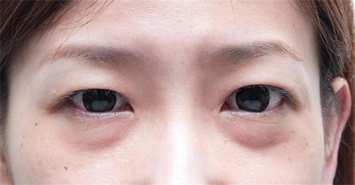 天生眼袋大的女人命运如何 运势好不好 一般