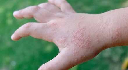 湿疹的发病原因是什么？湿疹都是因为环境潮湿引发的吗？