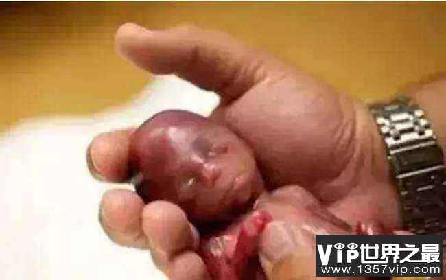 世界最小男婴出生时体重仅有268g