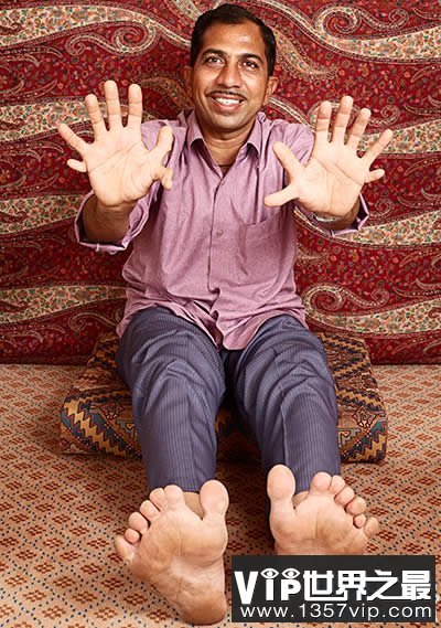 世界上最多的手指和脚趾，一共有28根(www.5300tv.com)