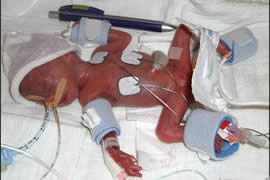 世界上最小的婴儿，五胞胎中最小孩子仅250克