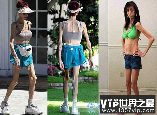 世界上最瘦的女人，像纸人一样(25公斤)(www.5300tv.com)
