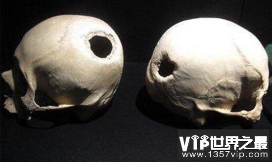 开颅手术是怎样的，5000年前就已能开头骨医治