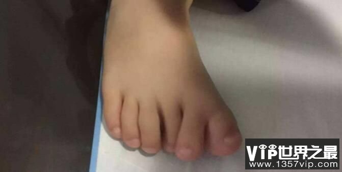 世界上脚趾最多的人：印度小男孩20根脚趾(患有多指症)