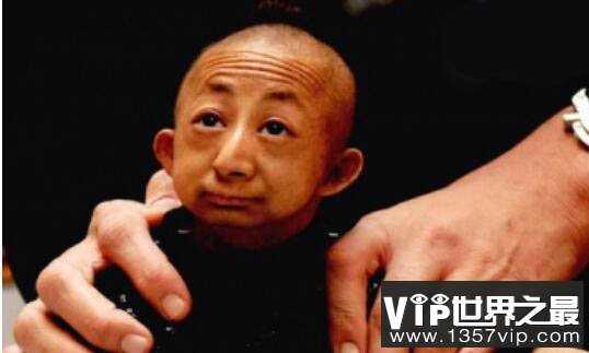 世界上最矮的人,何平平的死因调查