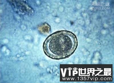 最常见的人体寄生虫,一年轻女子全身长满了寄生虫