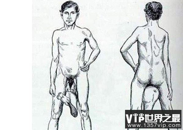 世界十大怪胎：狮面人上榜，竟存在拥有两个阴茎的男人