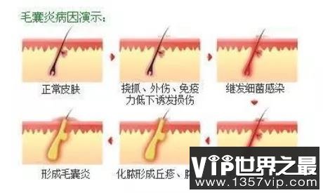 丁丁上长了痘痘，红肿发炎怎么办？