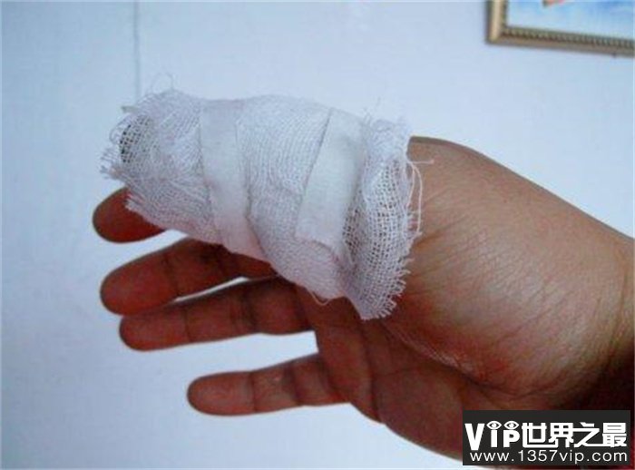 妻子要求买项链被拒绝 丈夫居然砍断自己手指（极端行为）