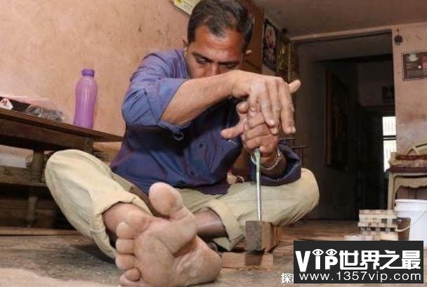 世界指头最多的人 来自印度的木匠有28个指头(患有多指症)