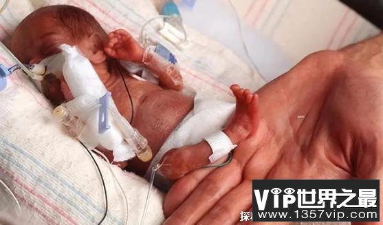 世界上最小的婴儿 出生仅280克身长24厘米(出生于美国)