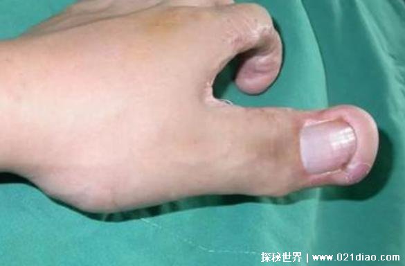 世界上最大的手指 食指的长度达到30厘米(影响较大)
