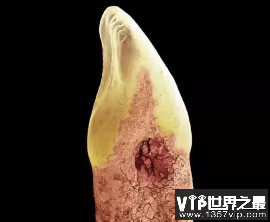 牙菌斑过多的表现有哪些 牙齿长牙菌斑了怎么办