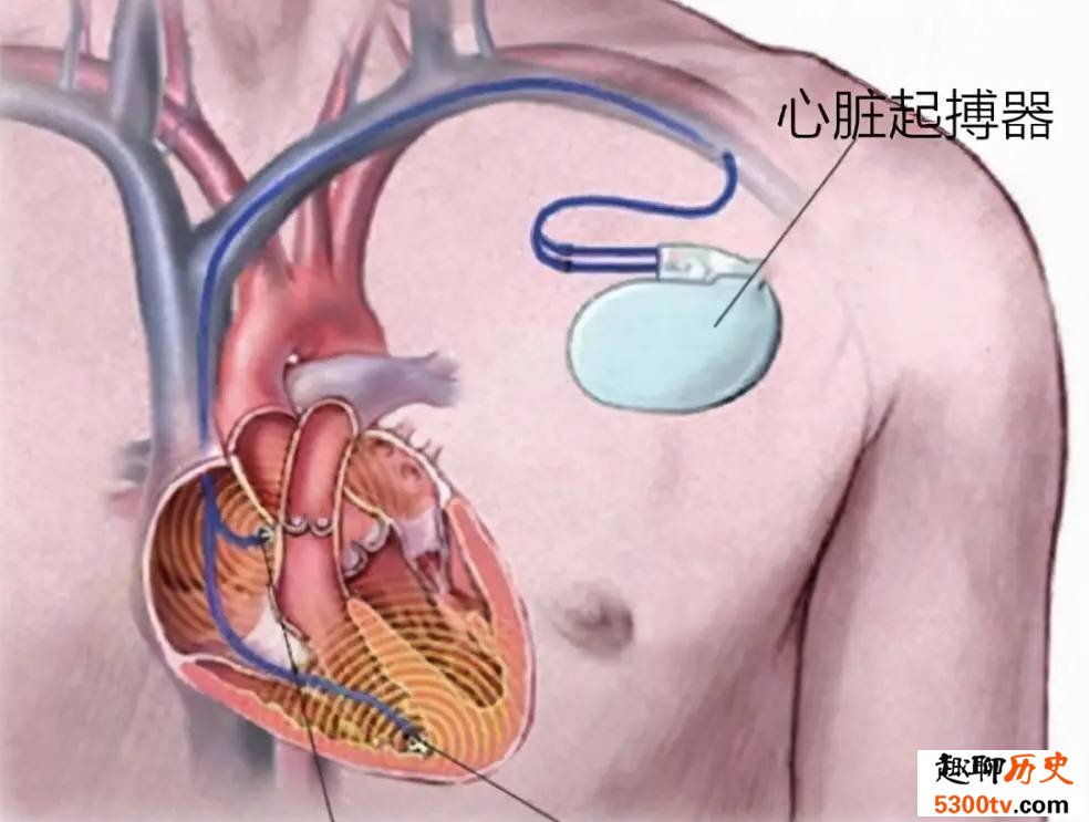 心脏起搏器是如何使心脏恢复跳动的