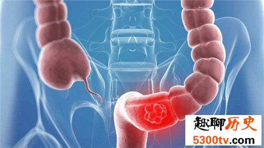 中国十大高发恶性肿瘤，早知征兆早预防