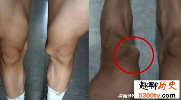 体育生左腿长瘤右腿挨刀6人被处理 事情发生的经过